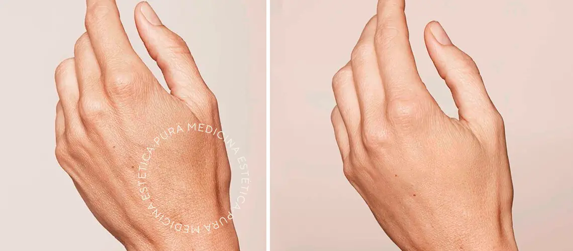 antes y después del rejuvenecimiento de manos