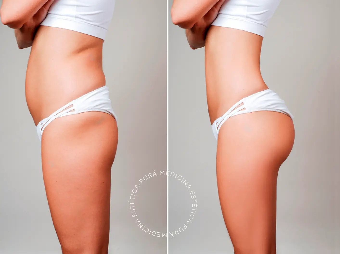 resultados de la carboxiterapia corporal antes y después