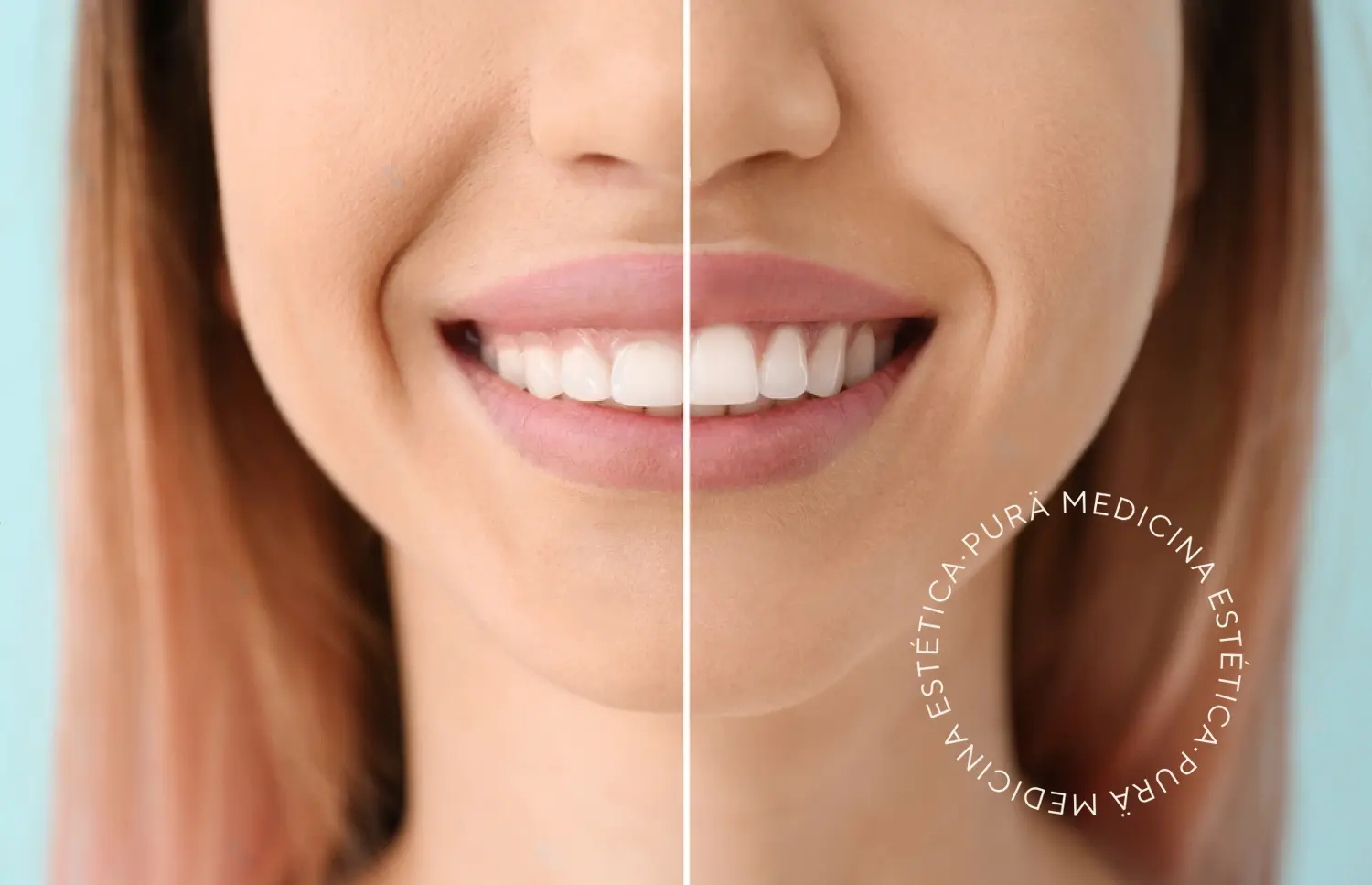 sonrisa gingival antes y después