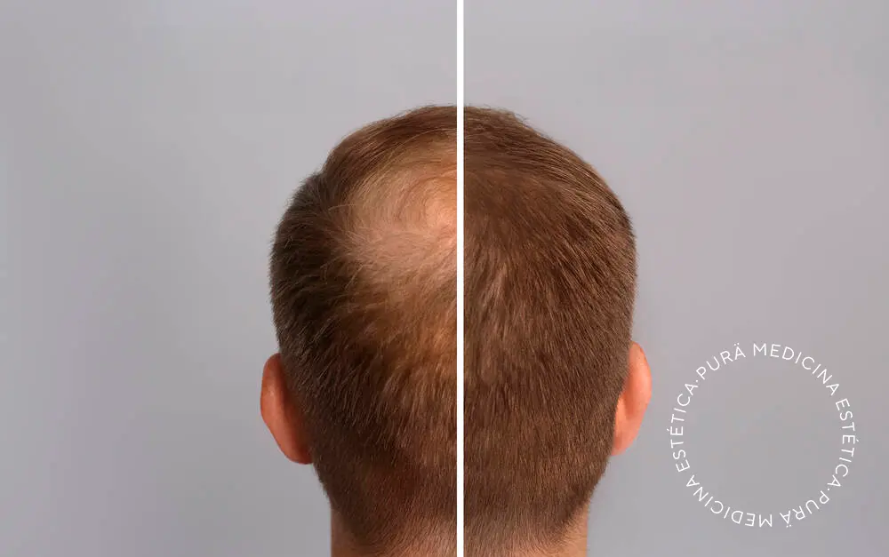 resultados de la mesoterapia capilar para alopecia