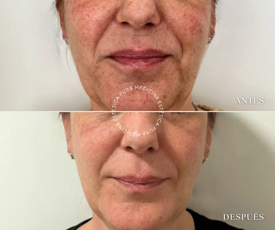 L ser IPL Para La Cuperosis Facial Tratamiento Con Luz Pulsada L ser IPL Para La Cuperosis Facial Tratamiento Con Luz Pulsada