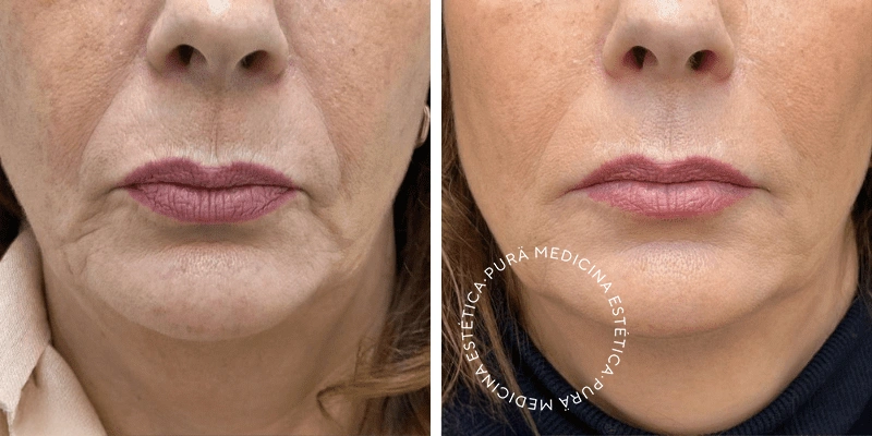 Want to Smooth Wrinkles See the real results from our patients