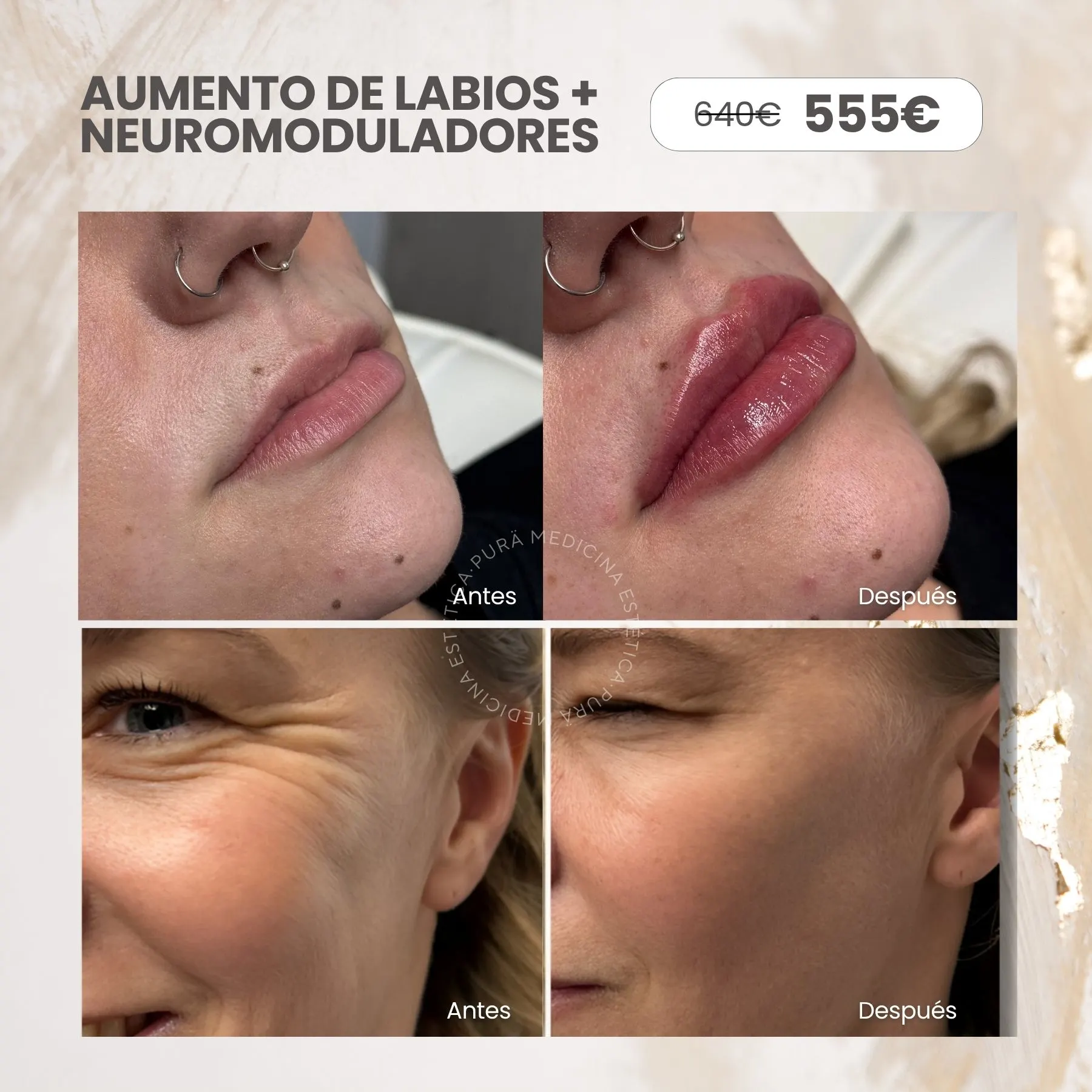 aumento de labios-neuromoduladores