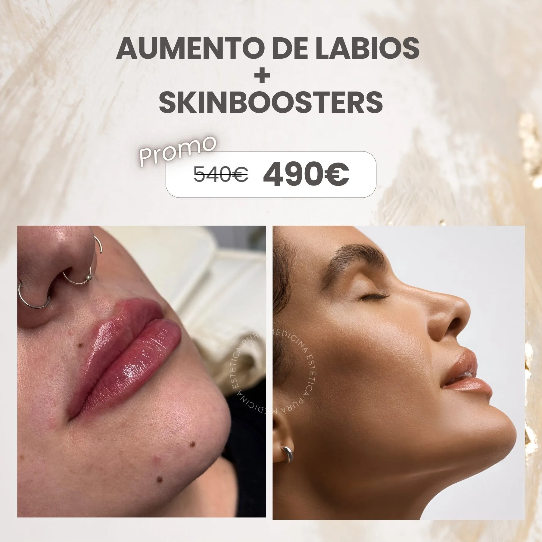 aumento de labios-skinboosters