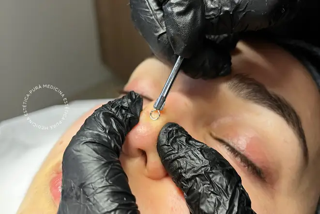 Cómo realizamos el tratamiento de limpieza facial en Malaga qué es la rinomodelación sin cirugía