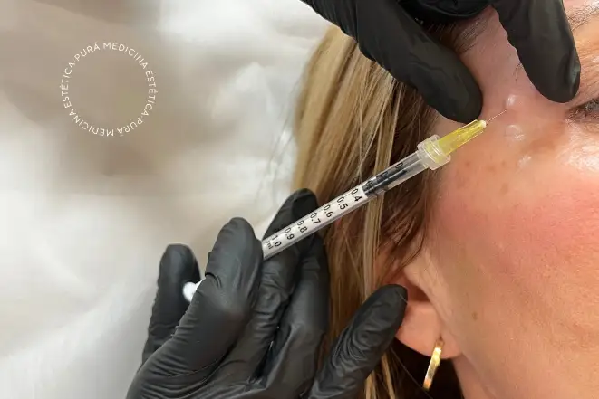 Neuromoduladores-en-Patas-de-Gallo Botox en Patas de Gallo