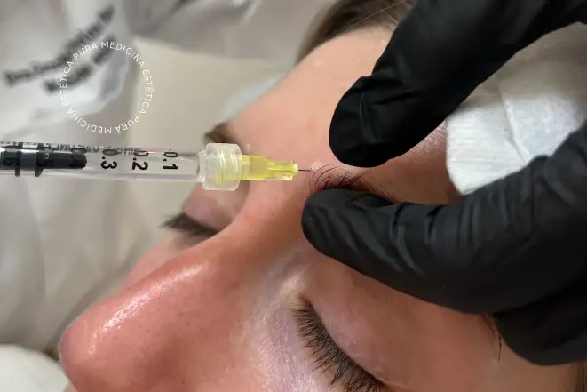 Neuromodulares-en-Entrecejo Botox en Entrecejo