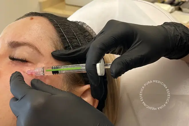 Aumento de Labios con ácido hialurónico
