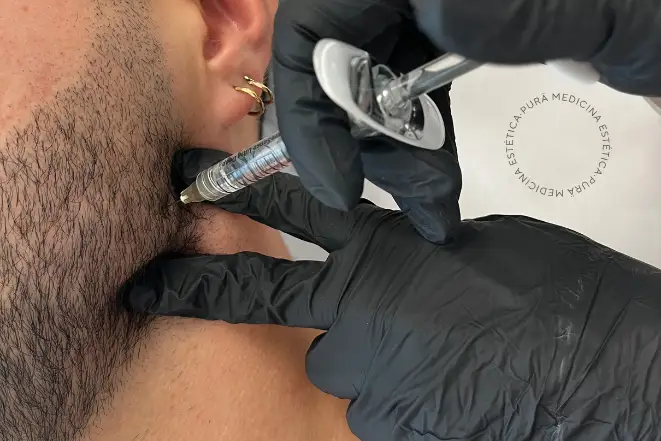 Qué cambios se consiguen con la Marcación Mandibular para quién está indicada la rinomodelación sin cirugía