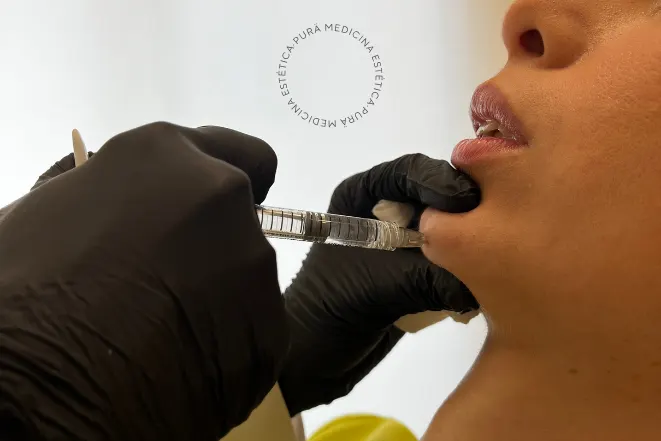 cuidados despues aumento labios con acido hialuronico