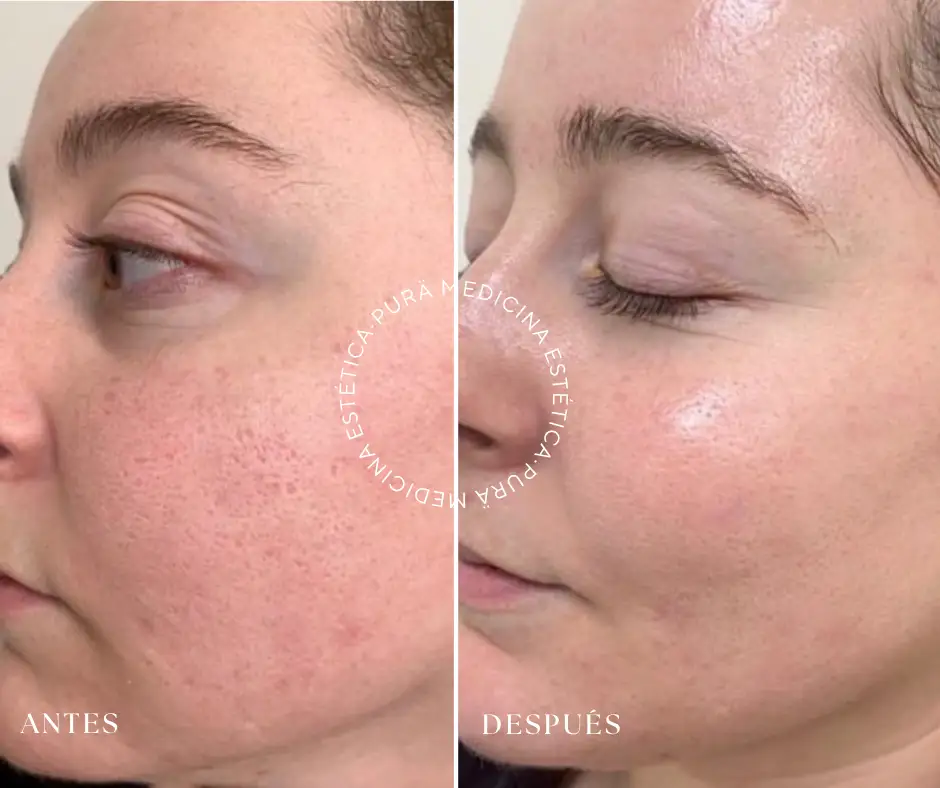 Resultados visibles con la técnica de microneedling Málaga