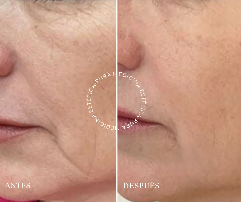 antes y después del hifu, tu lifting facial sin cirugía