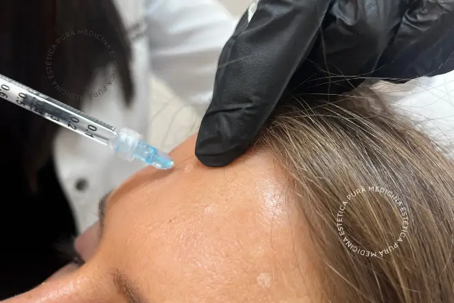Aumento de Labios con ácido hialurónico
